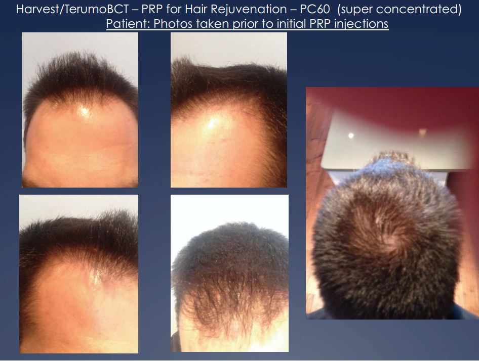 PRP For Hair Loss | Chicago Pain and Wellness Institute